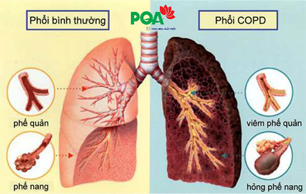 phổi tắc nghẽn mãn tính